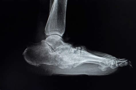 charcot left foot icd 10 212A may differ